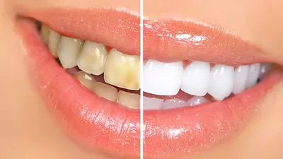 Желтые зубы: есть ли причины для беспокойства?