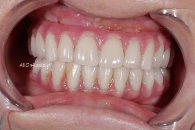 Пациент В. - верхние и нижние зубы по протоколу \"All-on-4\"