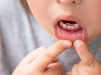 Зубы в два ряда у ребенка: почему коренные растут второй рядностью у детей  и что делать, если есть двойной рост молочных единиц