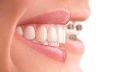 Статья о стоматологии: Ровные зубы без брекетов – это возможно?