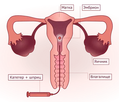 ЭКО в Корее с Вероникой ekovkoree@bk.ru тел.(WhatsApp): +82-10-5208-1368:  3-х или 5-и дневные эмбрионы. В чем разница?