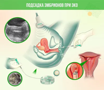 Почему во время развития in vitro иногда происходит остановка эмбриона? —  Reprolife