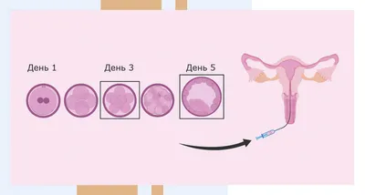 Какие эмбрионы переносить? 3-х дневные или 5-ти дневные эмбрионы