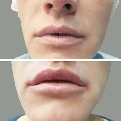 Увеличение губ канюлей | filler.by