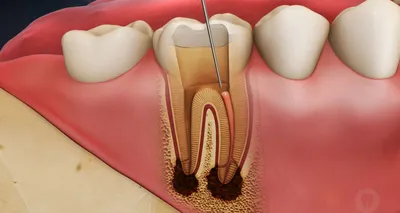 Лечение корневых каналов - Simetria Dentica