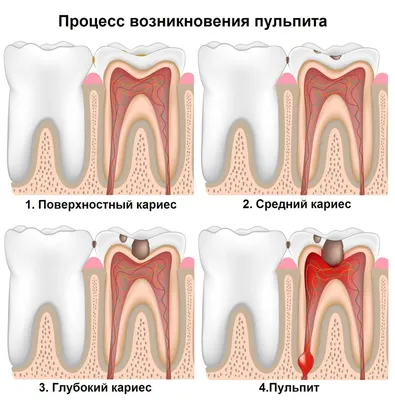 Пульпит | Стоматология «АльтоДент» в Орехово-Зуево