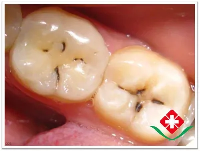 Лечение кариеса зубов (глубокий, профилактика) в Хейхэ (Китай),  стоматология МИРА