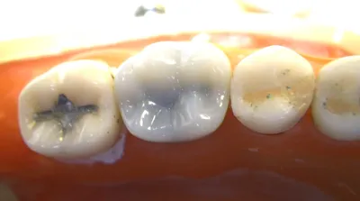 Кариес зубов: симптомы, лечение | Круглосуточная стоматология в Перми  София-Дента