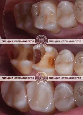 Лечение зубов - Врач стоматолог-терапевт Филатова П.А.