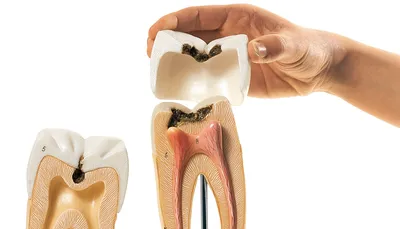 Лечение скрытого кариеса в СПб - Цены на лечение кариеса внутри зуба