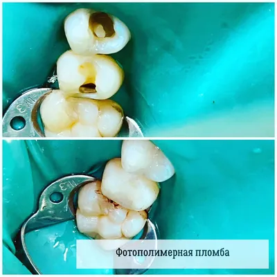 Лечение зубов в Запорожье | Качественное лечение зубов Dental Studio