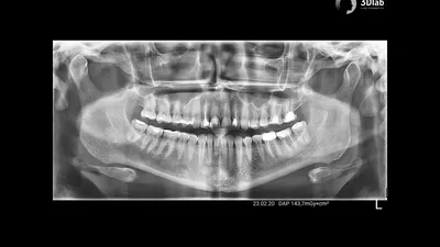 Кариес, который при лечении мог вызвать перфорацию - Терапия - Форум  стоматологов (стомотологический форум) - Профессиональный стоматологический  портал (сайт) «Клуб стоматологов»