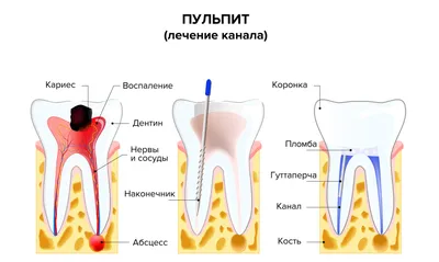 Лечение пульпита зуба без боли - стоматология Киев