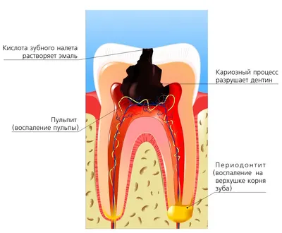 Лечение каналов зуба (лечение пульпита и лечение периодонтита) |  Медицинский Центр в Одинцово ОДИНМЕД. Многопрофильный медцентр