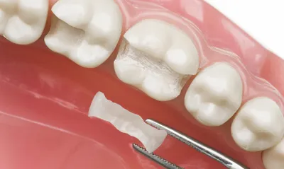 Микропротезирование зубов: особенности, плюсы и минусы