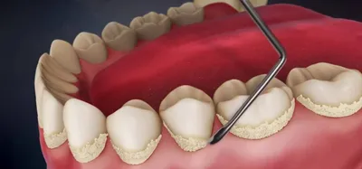 Зубной камень: причины, лечение, профилактика | Как избавиться от зубного  камня