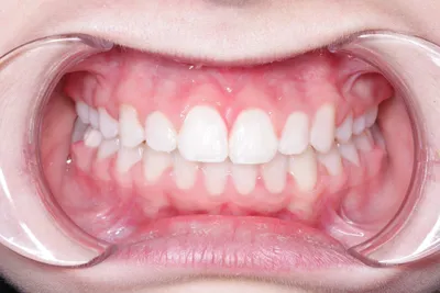Ортодонтия для детей - Стоматологический центр \"Ланси\" - Женева