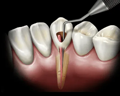 Современное, безболезненное лечение каналов зубов, в Уфе