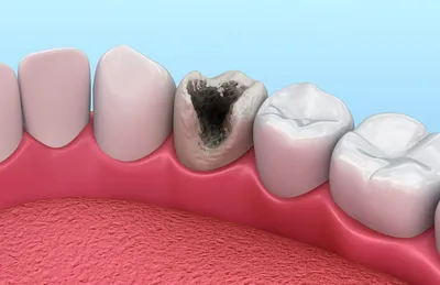 Пульпит : справочник стоматологических заболеваний