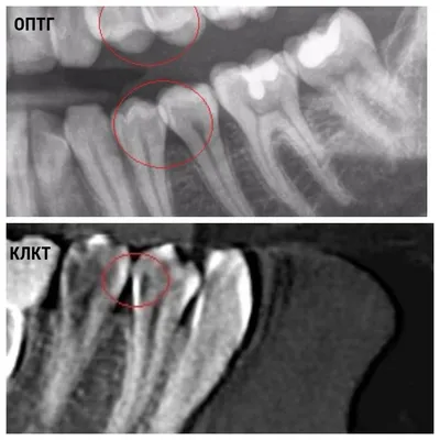 № 4 Почему в разных клиниках у Вас обнаружат разное количество зубов с  кариесом... | Пикабу