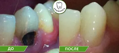 Лечение кариеса зубов Екатеринбург цена от 3000 руб.