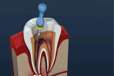 Пятна на зубах - причины, симптомы, цены на лечение в стоматологии Celt