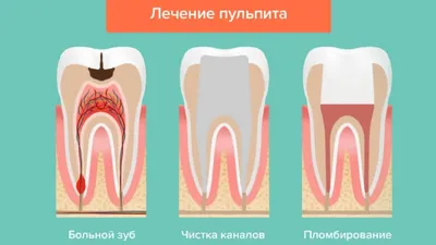 Кариес: симптомы, характеристики, осложнения