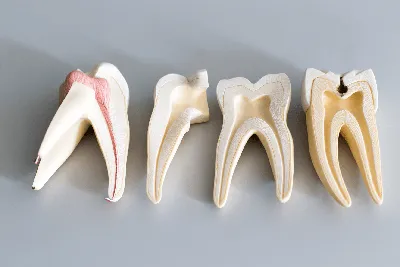 Темные делишки наших зубов: кариес