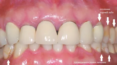 Оголение шейки зубов - быстрое и качественное лечение без боли!