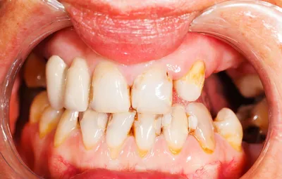 Клиновидный дефект зубов: что это такое?