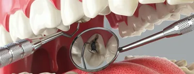 Классификация кариеса. Как стоматологи выбирают технику лечения  Стоматология Dental Way в Москве и Московской области | Dental Way