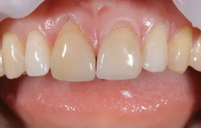 Оголение шейки зуба - причины и лечение