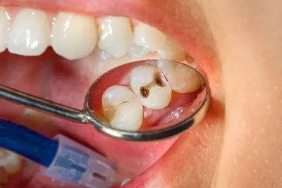 Лечение кариеса зубов в Кисловодске недорого в клинике \"Современная  стоматология\"