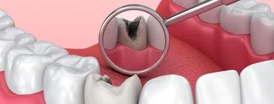 Лечение глубокого кариеса зубов
