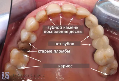 Эффективная защита зубов благодаря новой NSX формуле