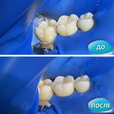 Имплантация зубов с ортодонтической подготовкой и тотальное протезирование  зубов керамикой