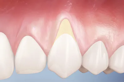 Оголение шейки зубов - быстрое и качественное лечение без боли!