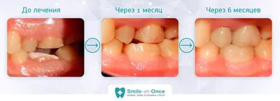 Аутотрансплантация и реплантация зубов – проведение операции в Москве  стоматологии Smile-at-Once
