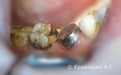 Кариес зубов - Стоматология