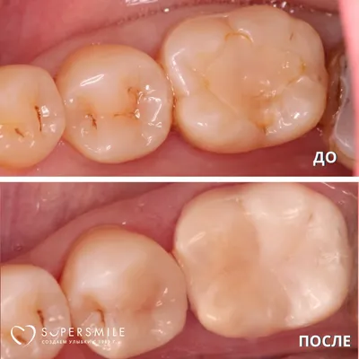 Лечение зубов (до/после)