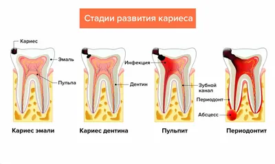 Лечение cреднего кариеса зубов, признаки, показания, цены