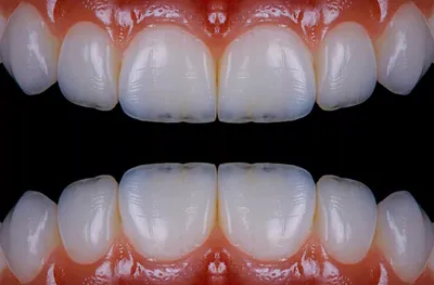 Что такое виниры? — стоматологическая клиника Эталон Ростов