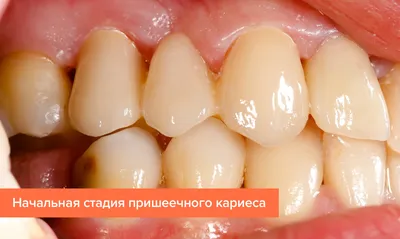 Лечение пришеечного кариеса ⚡ по старой цене в Москве ⚡ | Стоматология  Ⓜ️Речной вокзал, Ⓜ️Беломорская