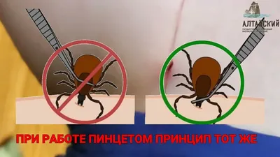 Где в Архангельской области кусают клещи, что делать, если укусил клещ, как  защититься от укуса клеща; куда нести клеща на проверку, что будет, если  укусит клещ - 20 мая 2022 - 29.ru