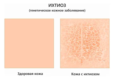 Периоральный дерматит: причины, симптомы и рекомендации по лечению  заболевания. Доктор Питер | DOCTORPITER