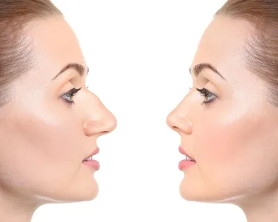 ᐉ Контурная пластика носа Запорожье ⭐ Косметологическая Клиника BeautyMED