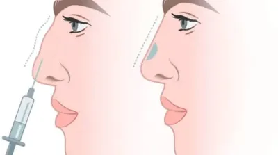 ᐉ Контурная пластика носа Запорожье ⭐ Косметологическая Клиника BeautyMED