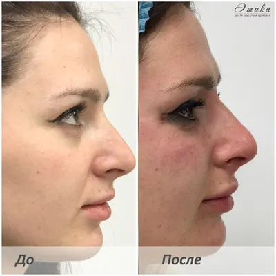 Ринопластика филлерами | Коррекция формы носа