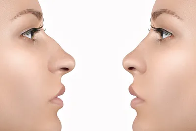 Контурная пластика носа без операции | Секреты красивой кожи