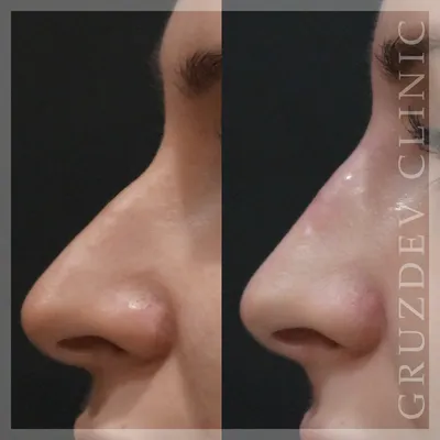 Контурная пластика носа - цены на контурную коррекцию формы носа филлерами  в СПб в клинике Груздева